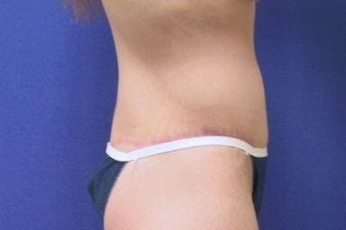 Dr. Cayce Rumsey Before & After Gallery - Patient 206489 - Image 2
