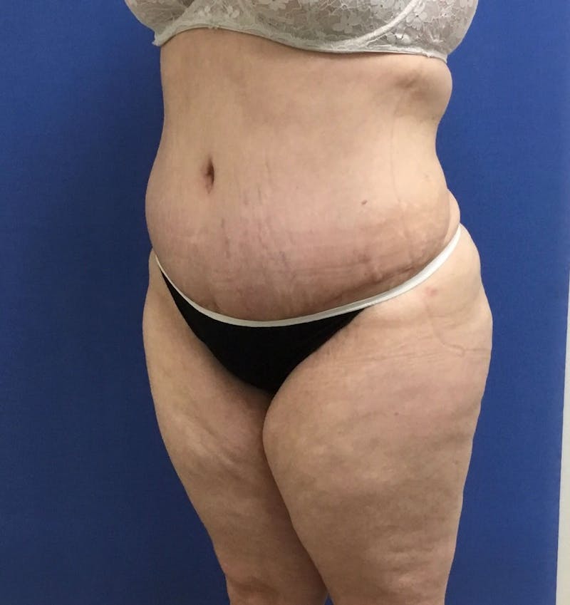 Dr. Cayce Rumsey Before & After Gallery - Patient 184325 - Image 4