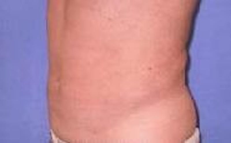 Dr. Cayce Rumsey Before & After Gallery - Patient 285496 - Image 4