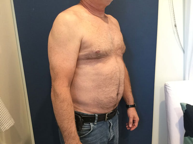 Dr. Cayce Rumsey Before & After Gallery - Patient 622970 - Image 2