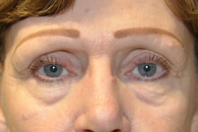 Dr. Erez Sternberg Before & After Gallery - Patient 174947 - Image 1