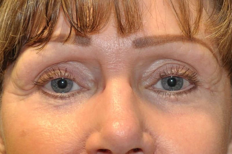 Dr. Erez Sternberg Before & After Gallery - Patient 174947 - Image 2