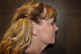 Dr. Erez Sternberg Before & After Gallery - Patient 174947 - Image 10