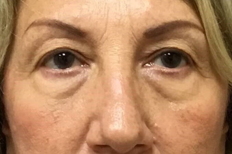 Dr. Cayce Rumsey Before & After Gallery - Patient 203477 - Image 1