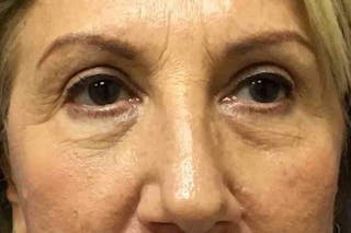 Dr. Cayce Rumsey Before & After Gallery - Patient 203477 - Image 2