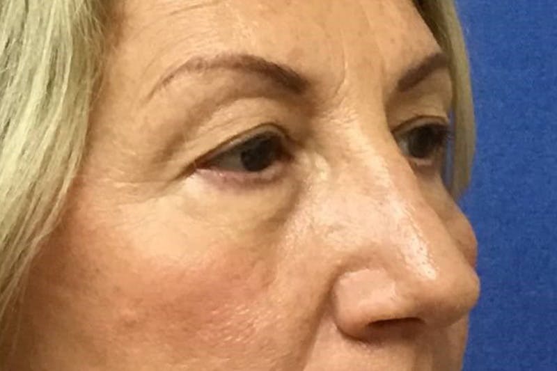 Dr. Cayce Rumsey Before & After Gallery - Patient 203477 - Image 3