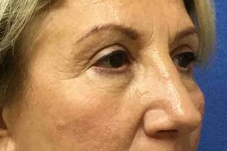 Dr. Cayce Rumsey Before & After Gallery - Patient 203477 - Image 4