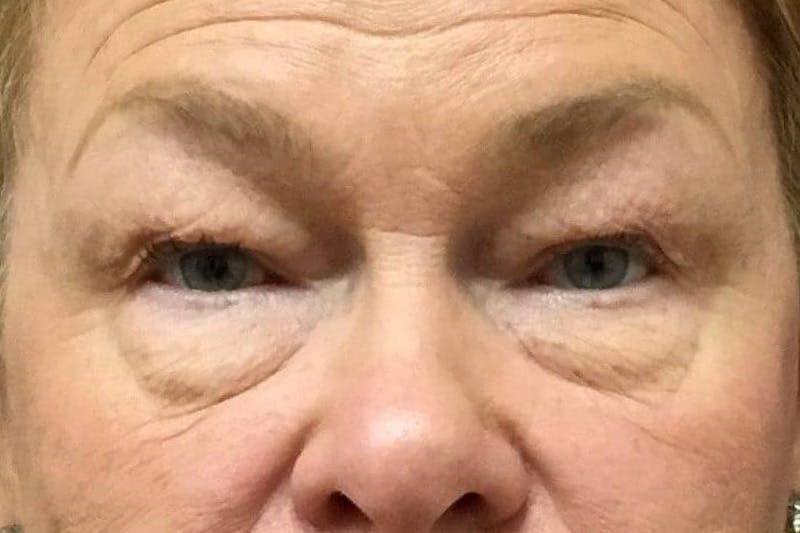 Dr. Cayce Rumsey Before & After Gallery - Patient 169651 - Image 1
