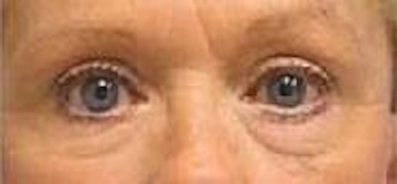 Eyelid Surgery Before & After Gallery - Patient 209407 - Image 2