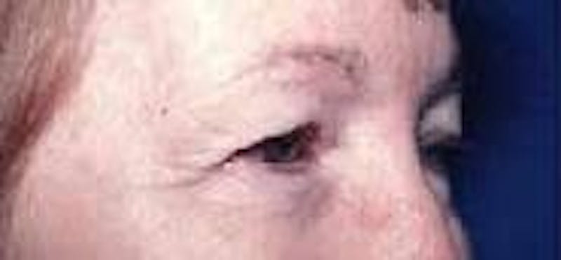 Dr. Cayce Rumsey Before & After Gallery - Patient 739847 - Image 3