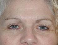 Brow Lift Before & After Gallery - Patient 294467 - Image 1