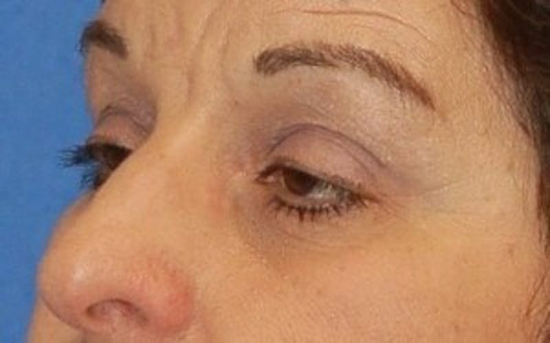 Eyelid Surgery Before & After Gallery - Patient 383898 - Image 3