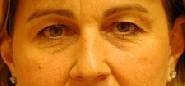Dr. Cayce Rumsey Before & After Gallery - Patient 149499 - Image 1