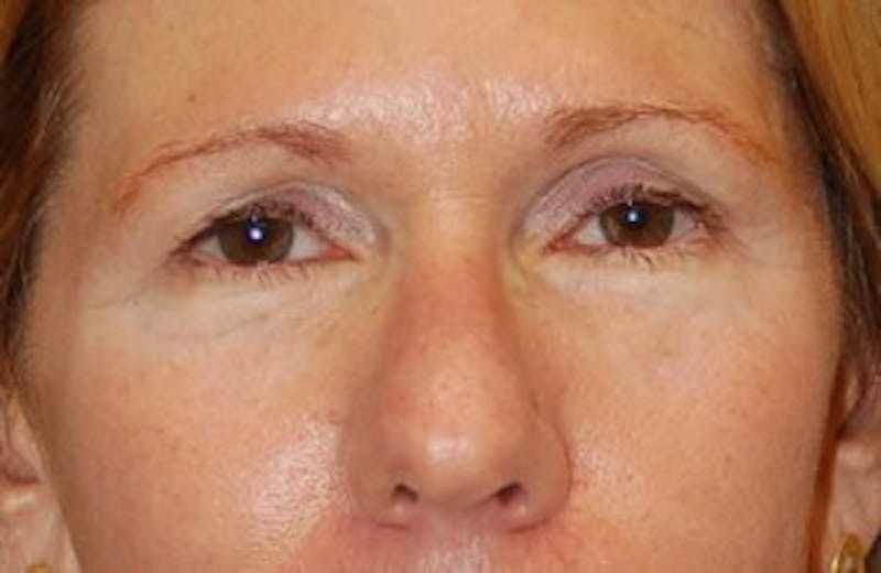 Eyelid Surgery Before & After Gallery - Patient 201937 - Image 1