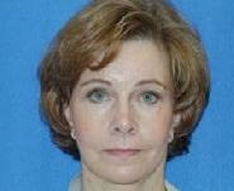 Brow Lift Before & After Gallery - Patient 369410 - Image 2