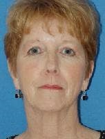 Brow Lift Before & After Gallery - Patient 366558 - Image 1
