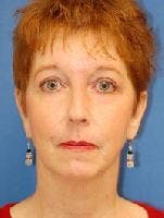 Brow Lift Before & After Gallery - Patient 366558 - Image 2