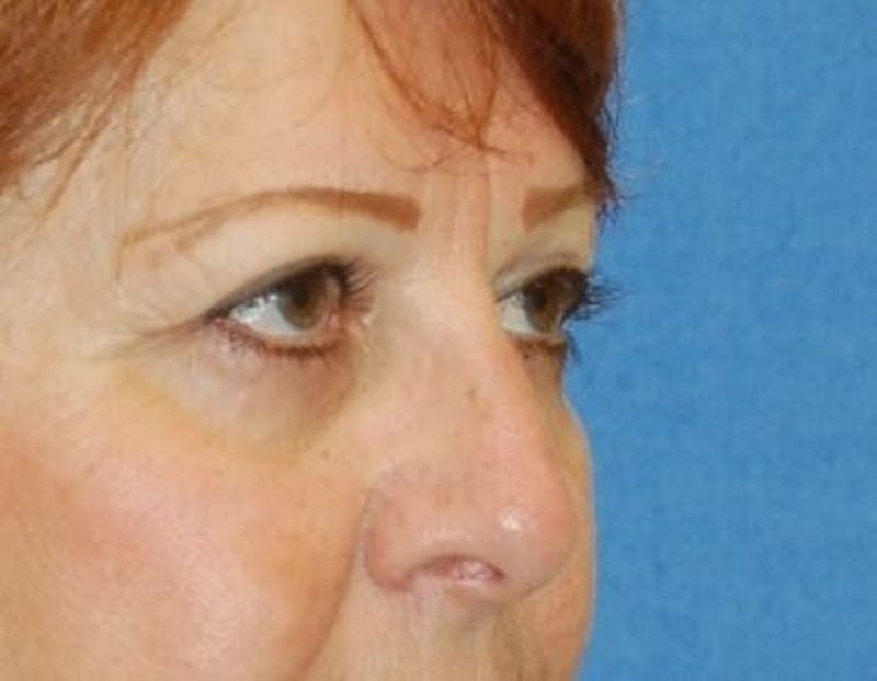 Eyelid Surgery Before & After Gallery - Patient 124095 - Image 4