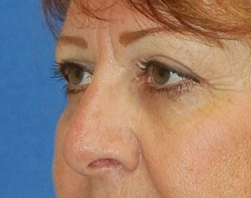 Eyelid Surgery Before & After Gallery - Patient 124095 - Image 6