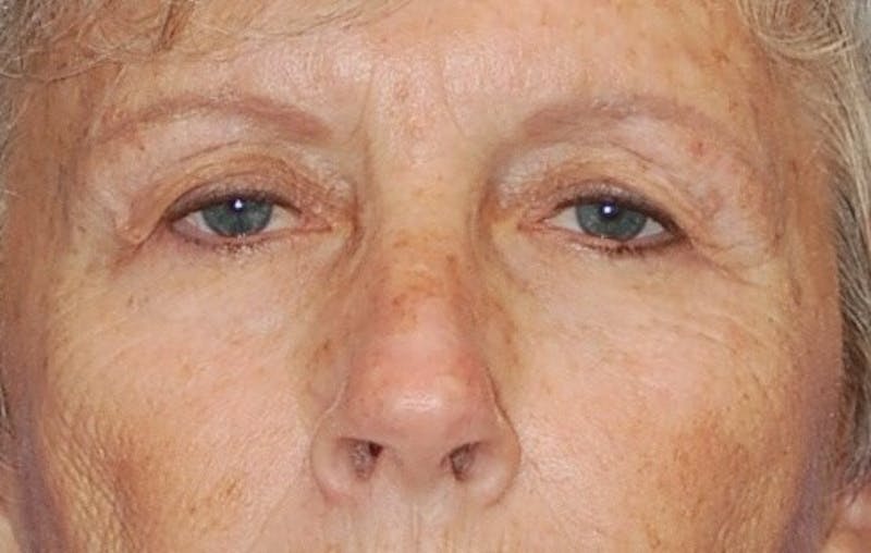Eyelid Surgery Before & After Gallery - Patient 200175 - Image 1