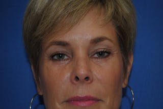 Brow Lift Before & After Gallery - Patient 150881 - Image 2