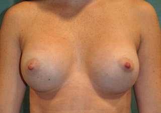 Dr. Erez Sternberg Before & After Gallery - Patient 123244 - Image 2