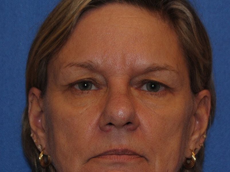 Brow Lift Before & After Gallery - Patient 319986 - Image 1