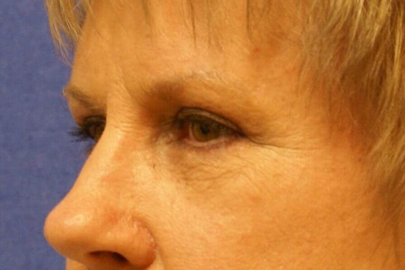 Dr. Cayce Rumsey Before & After Gallery - Patient 251833 - Image 6