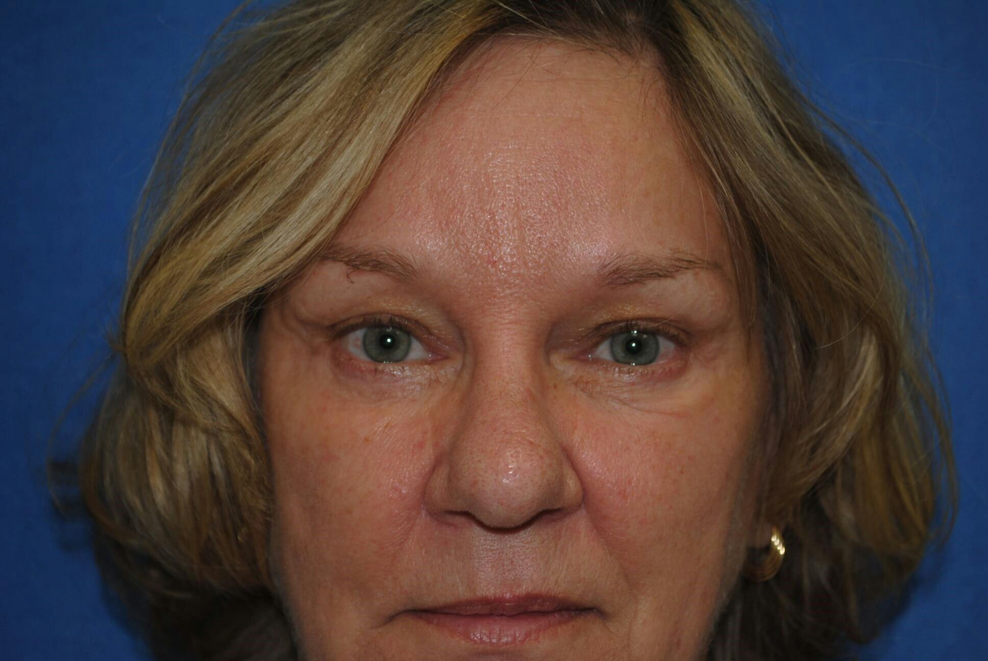 Brow Lift Before & After Gallery - Patient 319986 - Image 2