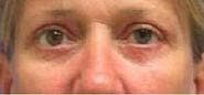 Dr. Cayce Rumsey Before & After Gallery - Patient 385604 - Image 2