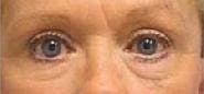 Dr. Cayce Rumsey Before & After Gallery - Patient 151751 - Image 2