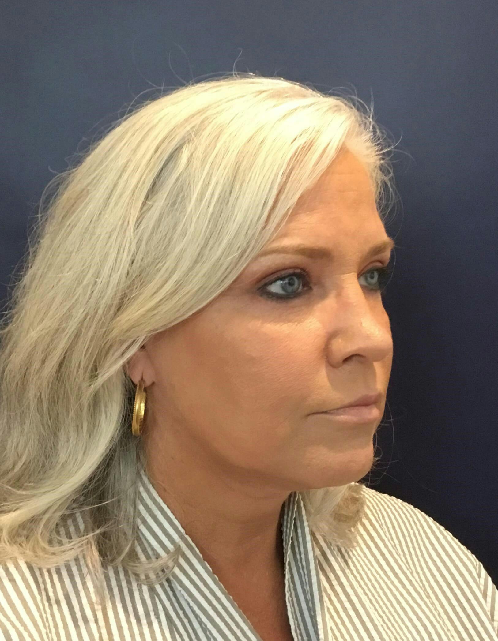 Dr. Cayce Rumsey Before & After Gallery - Patient 138251 - Image 2