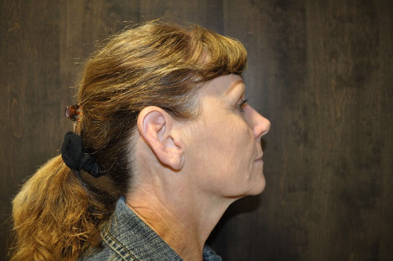 Eyelid Surgery Before & After Gallery - Patient 185202 - Image 5