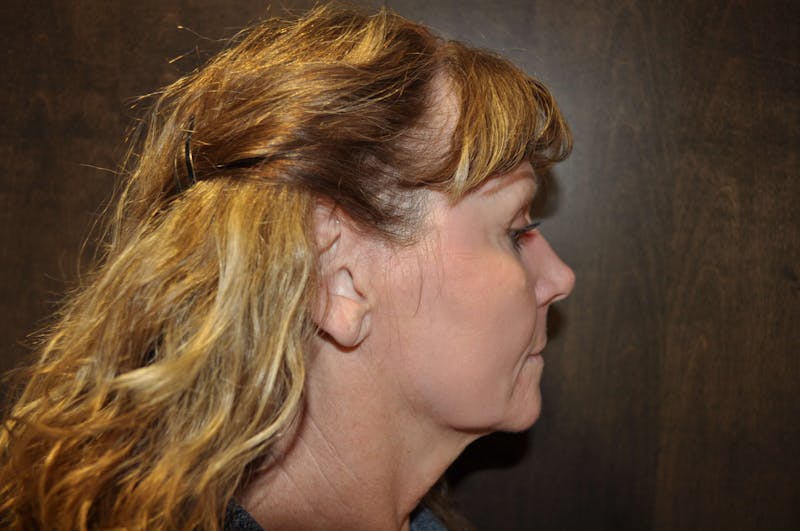 Eyelid Surgery Before & After Gallery - Patient 185202 - Image 6