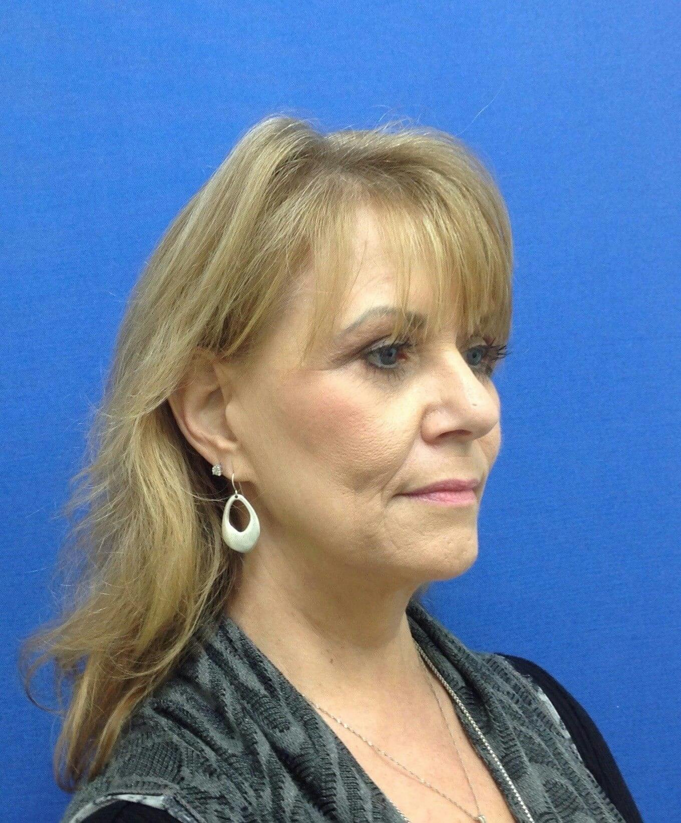 Dr. Cayce Rumsey Before & After Gallery - Patient 180244 - Image 2