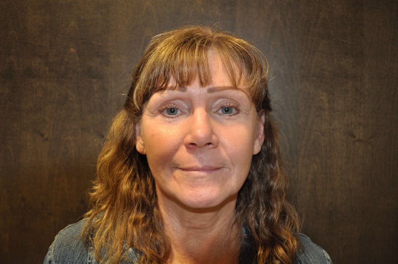 Eyelid Surgery Before & After Gallery - Patient 185202 - Image 8