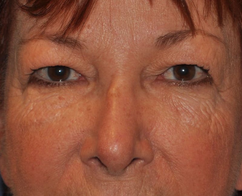 Eyelid Surgery Before & After Gallery - Patient 820013 - Image 1