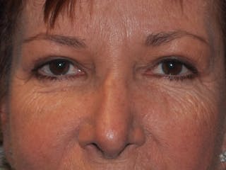 Eyelid Surgery Before & After Gallery - Patient 820013 - Image 2