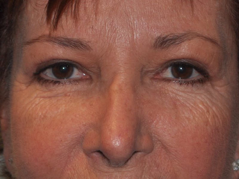 Eyelid Surgery Before & After Gallery - Patient 820013 - Image 2