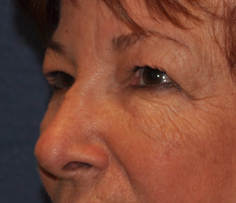 Eyelid Surgery Before & After Gallery - Patient 820013 - Image 3