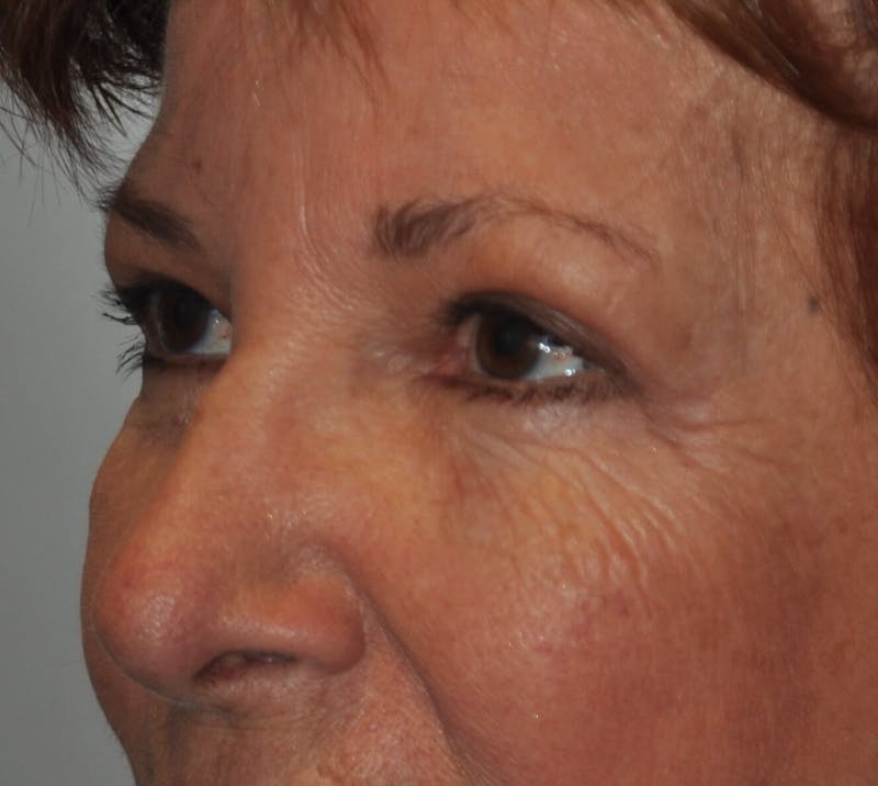 Eyelid Surgery Before & After Gallery - Patient 820013 - Image 4