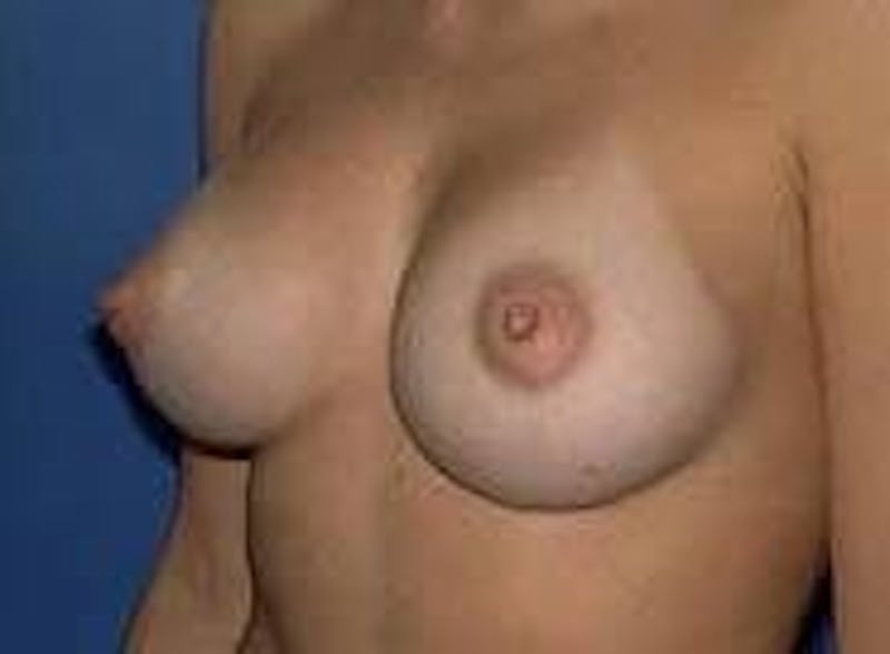 Breast Augmentation Before & After Gallery - Patient 423245 - Image 4
