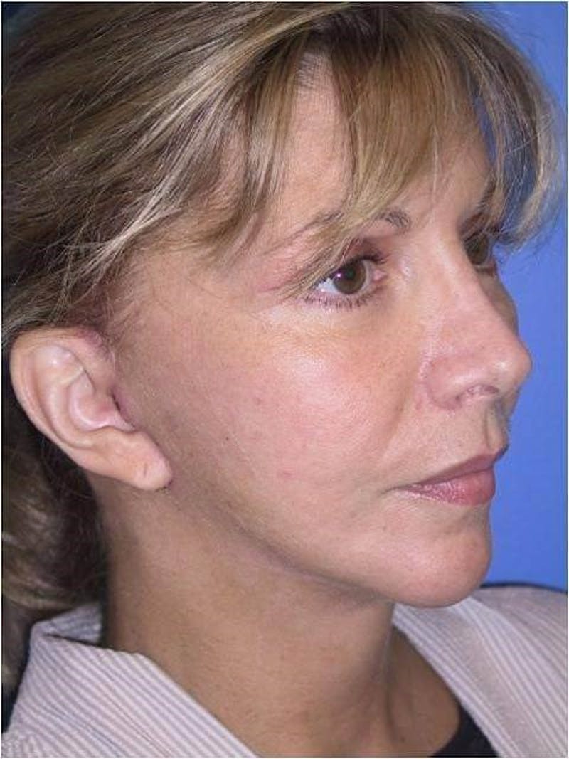 Dr. Cayce Rumsey Before & After Gallery - Patient 305400 - Image 2