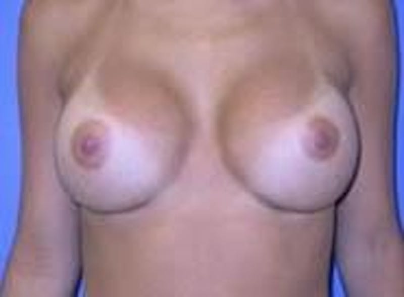 Breast Augmentation Before & After Gallery - Patient 266240 - Image 2