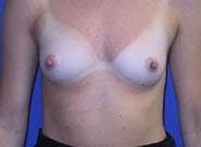 Breast Augmentation Before & After Gallery - Patient 249843 - Image 1