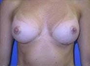 Breast Augmentation Before & After Gallery - Patient 249843 - Image 2