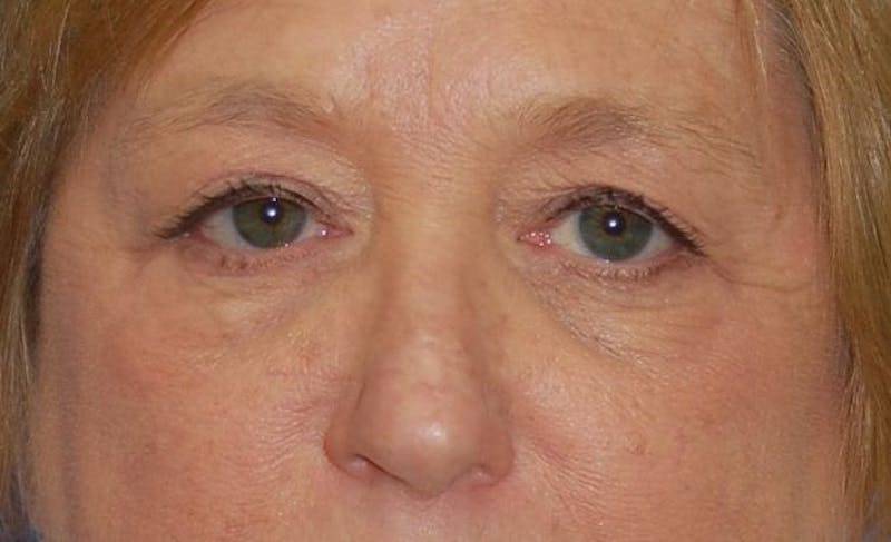 Eyelid Surgery Before & After Gallery - Patient 248924 - Image 1