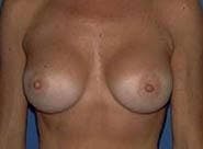 Breast Augmentation Before & After Gallery - Patient 134659 - Image 2