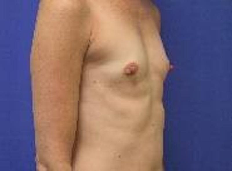 Breast Augmentation Before & After Gallery - Patient 150451 - Image 5