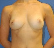 Breast Augmentation Before & After Gallery - Patient 192184 - Image 1
